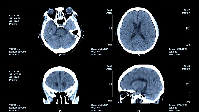 大脑扫描图像视频素材