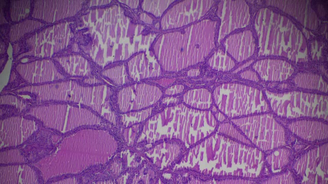 光镜下中毒性甲状腺肿(甲状腺亢进)视频素材