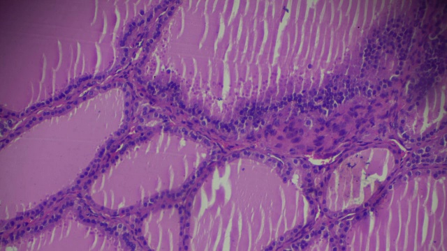 光镜下中毒性甲状腺肿(甲状腺亢进)视频素材