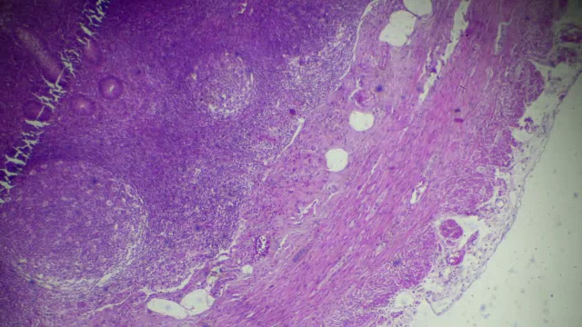 急性单纯阑尾炎人病理标本的显微镜观察视频素材