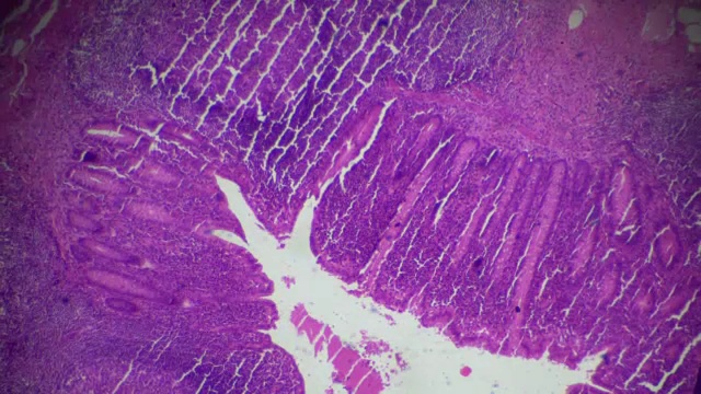 慢性阑尾炎光镜下病理分析视频素材