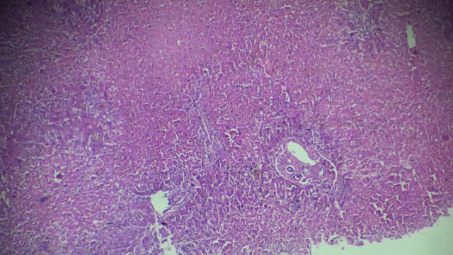不同部位光镜下肝活检慢性充血视频素材