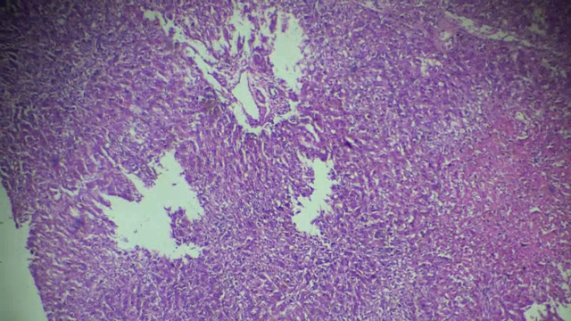 不同部位光镜下肝活检慢性充血视频素材