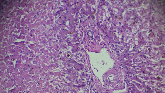 不同部位光镜下肝活检慢性充血视频素材