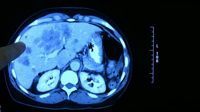 肝病高清视频素材