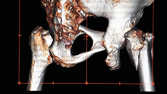 骨盆和髋关节解剖三维渲染从CT扫描仪。视频素材