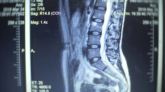 关闭。核磁共振成像的x射线图像。在电脑屏幕上显示磁共振治疗的结果。4k，模糊了帧边界。视频素材
