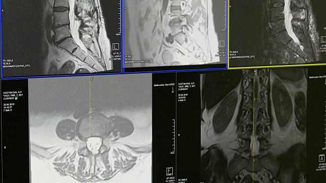 MRI上的脊髓和脊柱断层扫描。视频素材