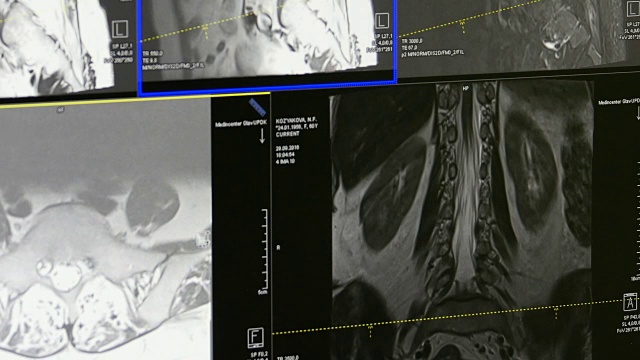 MRI上的脊髓和脊柱断层扫描。视频素材