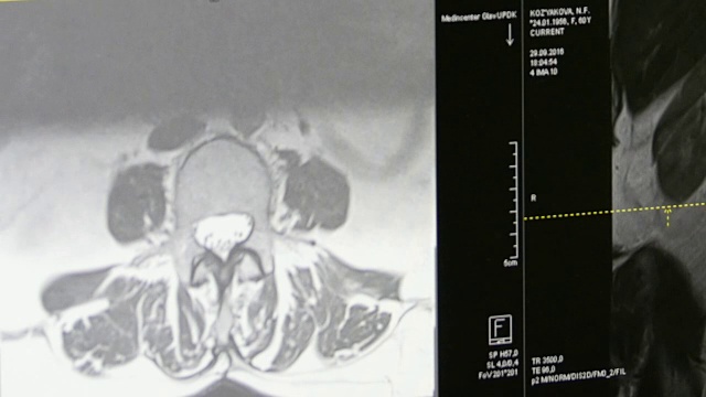 MRI上的脊髓和脊柱断层扫描。视频素材