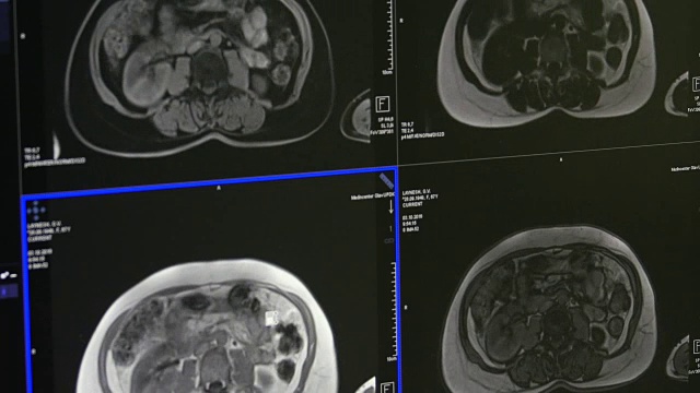 MRI脑部断层扫描专业医疗设备。视频素材