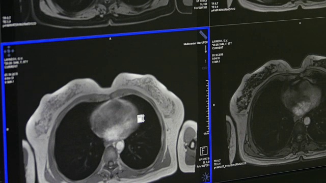 MRI脑部断层扫描专业医疗设备。视频素材