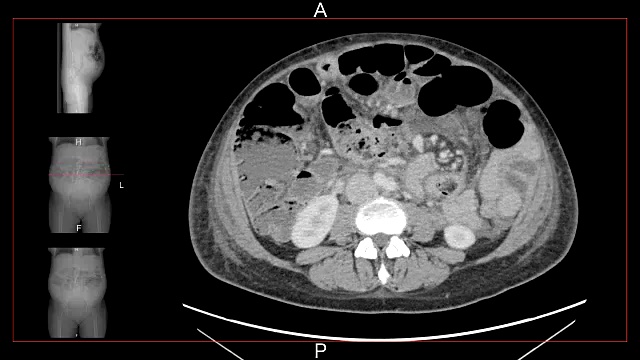 计算机轴向断层扫描对女性腹部和骨盆的扫描视频素材