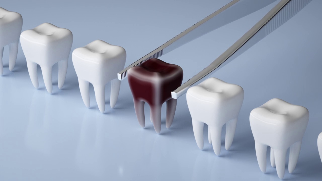 医学3D模拟拔除蛀牙牙科视频下载