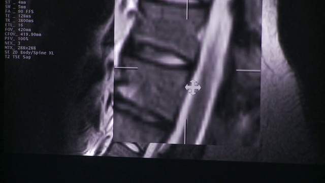 美国佛蒙特州南伯灵顿市，计算机屏幕上的ECU TU TD脊柱x射线图像，放大工具在其周围滚动视频素材