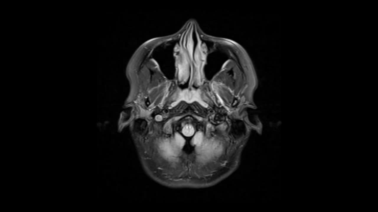 大脑的核磁共振成像。人类头骨垂直投影。医疗镜头。疾病的预防和诊断。神经系统视频素材