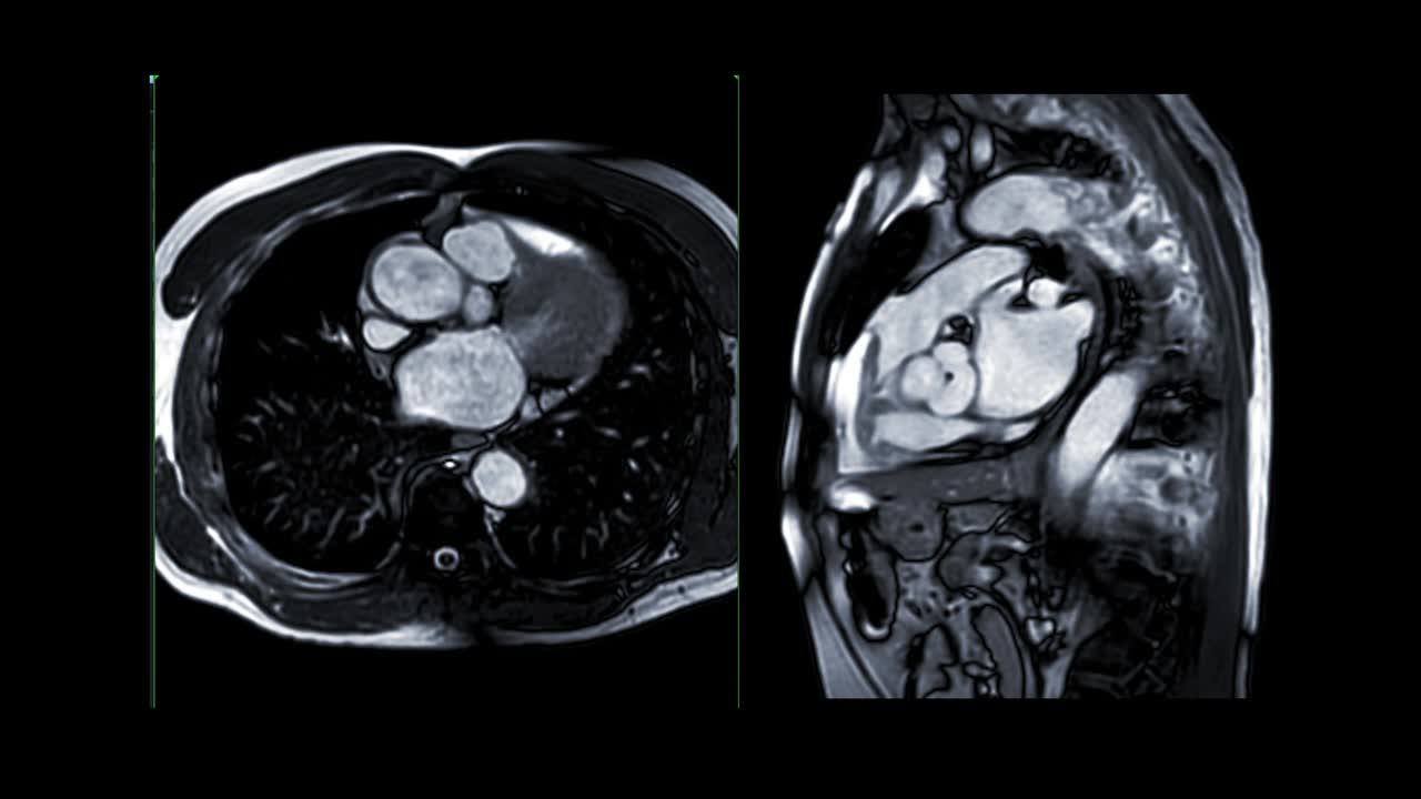 心脏MRI或心脏MRI(心脏磁共振成像)显示心脏跳动，以检测心脏病。视频素材画面1