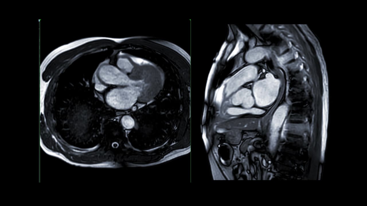 心脏MRI或心脏MRI(心脏磁共振成像)显示心脏跳动，以检测心脏病。视频素材画面2