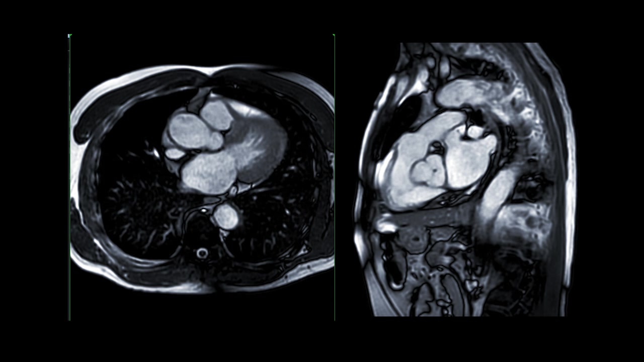 心脏MRI或心脏MRI(心脏磁共振成像)显示心脏跳动，以检测心脏病。视频素材画面4