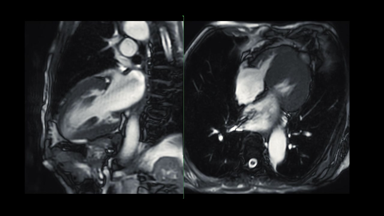 心脏MRI或心脏MRI(心脏磁共振成像)显示心脏跳动，以检测心脏病。视频素材画面1