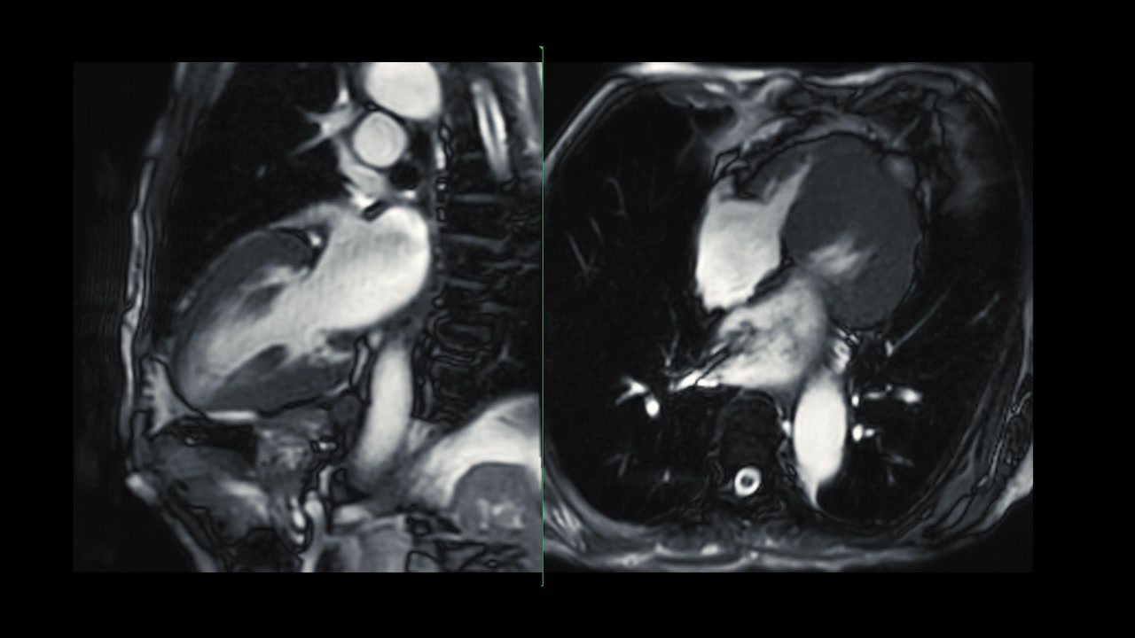 心脏MRI或心脏MRI(心脏磁共振成像)显示心脏跳动，以检测心脏病。视频素材画面3
