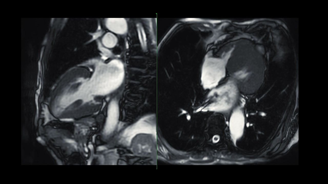 心脏MRI或心脏MRI(心脏磁共振成像)显示心脏跳动，以检测心脏病。视频素材画面4
