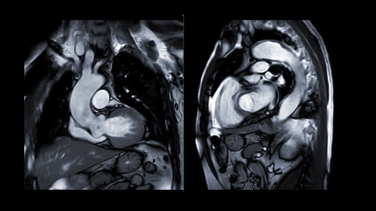 心脏MRI或心脏MRI(心脏磁共振成像)显示心脏跳动，以检测心脏病。视频素材画面1