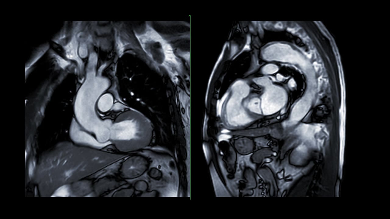心脏MRI或心脏MRI(心脏磁共振成像)显示心脏跳动，以检测心脏病。视频素材画面2