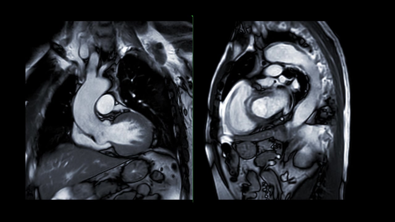 心脏MRI或心脏MRI(心脏磁共振成像)显示心脏跳动，以检测心脏病。视频素材画面3