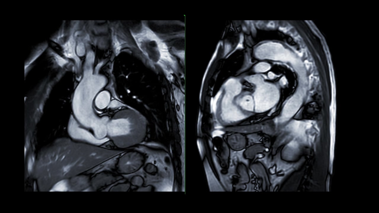 心脏MRI或心脏MRI(心脏磁共振成像)显示心脏跳动，以检测心脏病。视频素材画面4