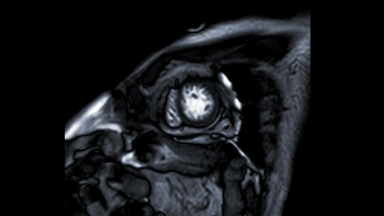 心脏MRI或心脏MRI(心脏磁共振成像)显示心脏跳动，以检测心脏病。视频素材画面1
