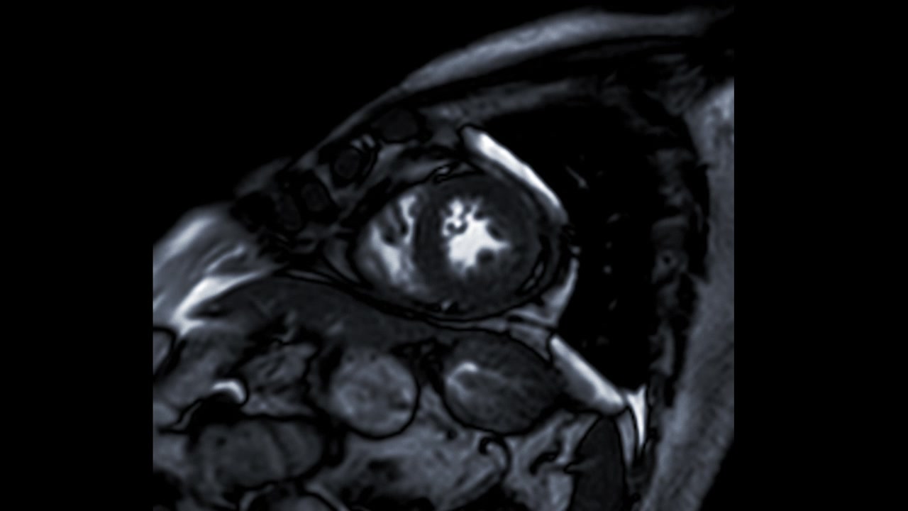 心脏MRI或心脏MRI(心脏磁共振成像)显示心脏跳动，以检测心脏病。视频素材画面2