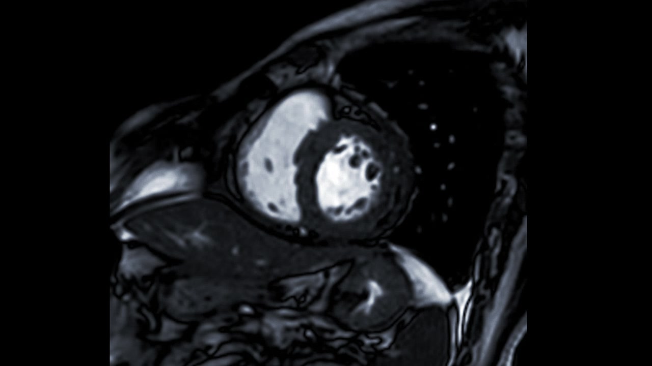 心脏MRI或心脏MRI(心脏磁共振成像)显示心脏跳动，以检测心脏病。视频素材画面3