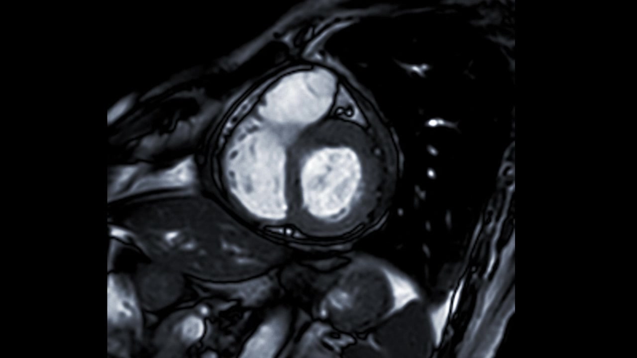 心脏MRI或心脏MRI(心脏磁共振成像)显示心脏跳动，以检测心脏病。视频素材画面4