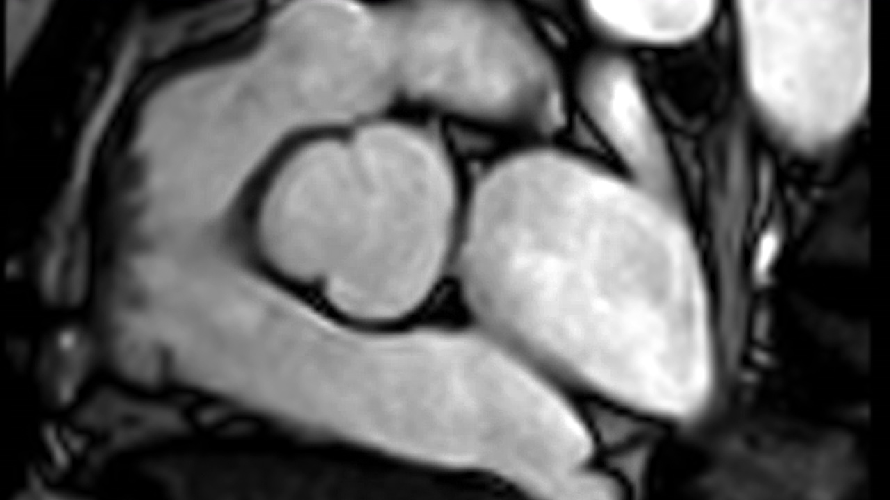 心脏MRI或心脏MRI或心脏磁共振成像显示主动脉瓣。视频素材画面1