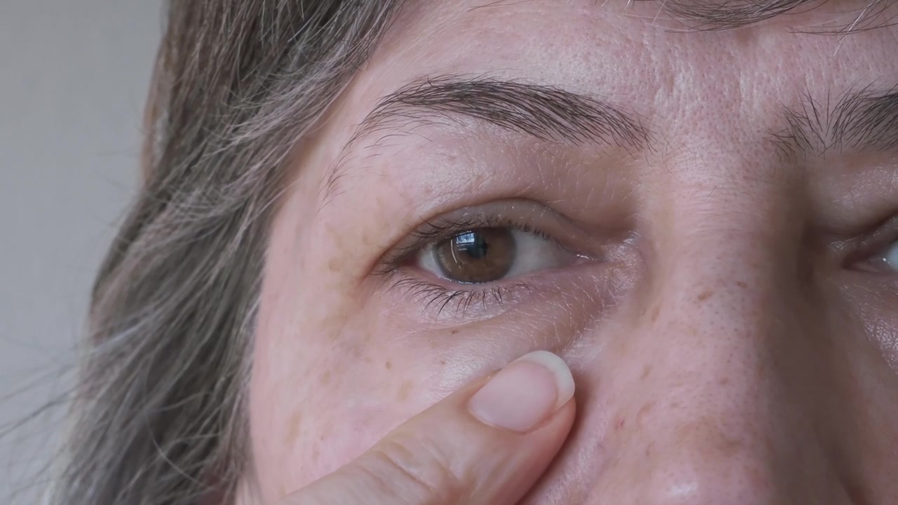 特写镜头：一位灰发女性的脸，正在检查她的眼袋和肿胀的上眼睑。面部整形手术、眼睑提升、眼睑成形术、美容视频素材画面3